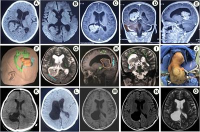 Resection of the tumor in the trigone of the lateral ventricle via the contralateral posterior interhemispheric transfalcine transprecuneus approach with multi-modern neurosurgery technology: a case report